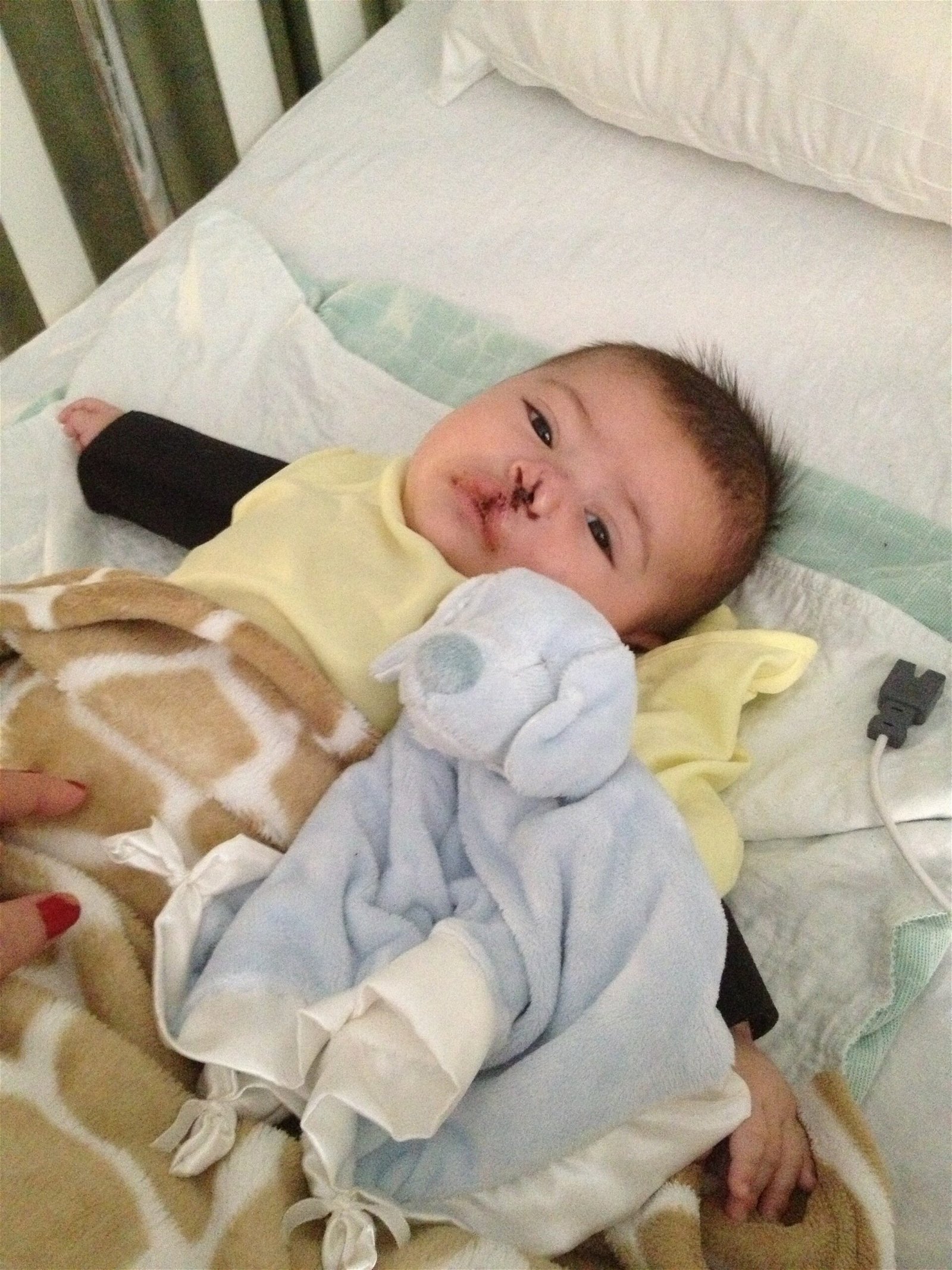 Baby Adriano recovering from his first surgery 